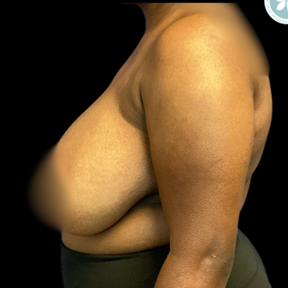 Breast Reduction Before & After Patient #4954