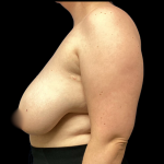 Breast Reduction Before & After Patient #4956