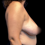 Breast Reduction Before & After Patient #4957