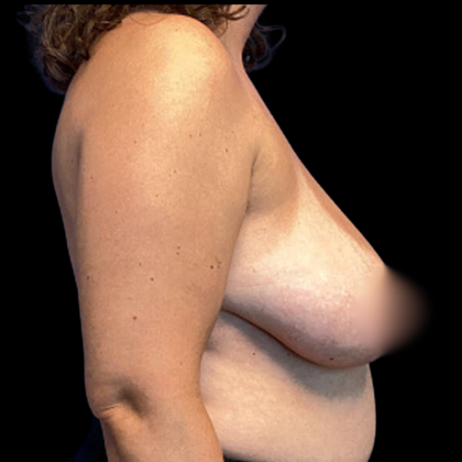 Breast Reduction Before & After Patient #4957