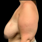 Breast Reduction Before & After Patient #4958