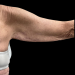 Arm Lift Before & After Patient #4891