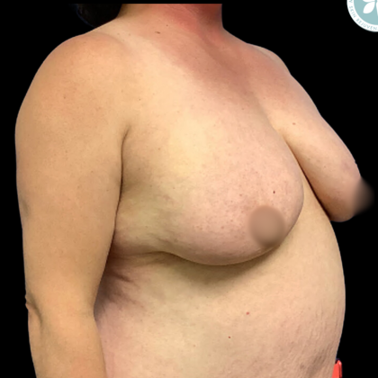 Breast Reduction Before & After Patient #4959