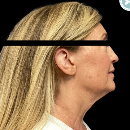 Facelift Before & After Patient #4960