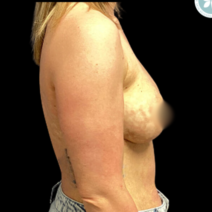Implant Removal Before & After Patient #4961