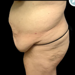 Liposuction Before & After Patient #4962