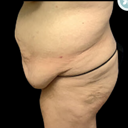 Liposuction Before & After Patient #4962