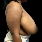 Breast Reduction Before & After Patient #4902