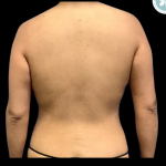 Liposuction Before & After Patient #4963
