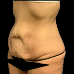 Tummy Tuck Before & After Patient #4965