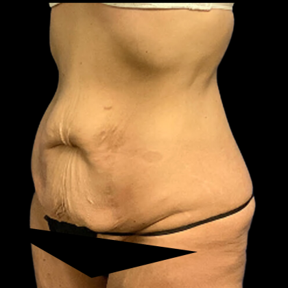 Tummy Tuck Before & After Patient #4965