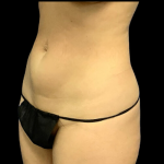 Tummy Tuck Before & After Patient #4967