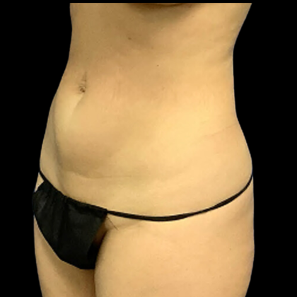 Tummy Tuck Before & After Patient #4967