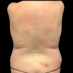 Tummy Tuck Before & After Patient #4968