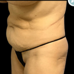 Tummy Tuck Before & After Patient #4970
