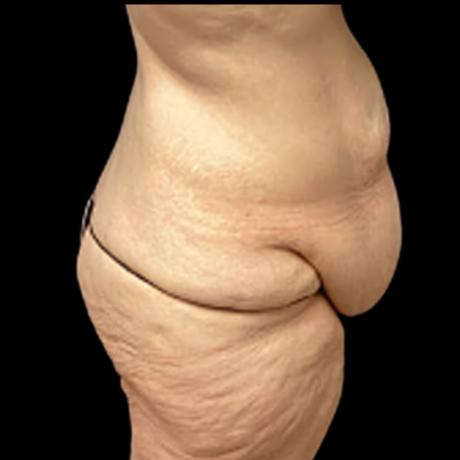 Tummy Tuck Before & After Patient #4972