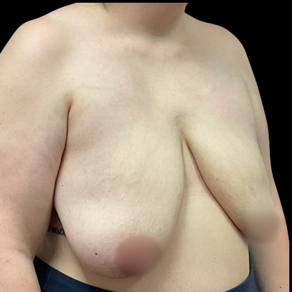 Breast Reconstruction Before & After Patient #4903