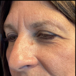 Blepharoplasty Before & After Patient #5079