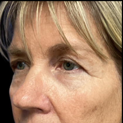 Blepharoplasty Before & After Patient #5080