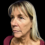 Facelift Before & After Patient #5081