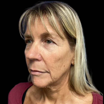 Facelift Before & After Patient #5081