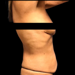 Mommy Makeover Before & After Patient #5082