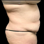 Tummy Tuck Before & After Patient #5084