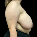 Breast Reduction Before & After Patient #5085