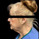 Facelift Before & After Patient #5086