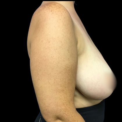 Breast Reduction Before & After Patient #4904