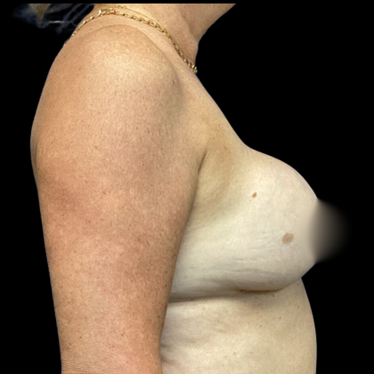 Implant Removal Before & After Patient #4906