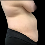 Mommy Makeover Before & After Patient #4907