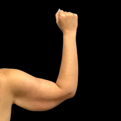 Arm Lift Before & After Patient #4947