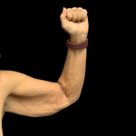 Arm Lift Before & After Patient #4948