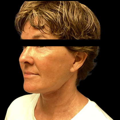 Facelift Before & After Patient #4890