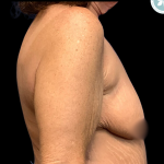Breast Augmentation Before & After Patient #4952