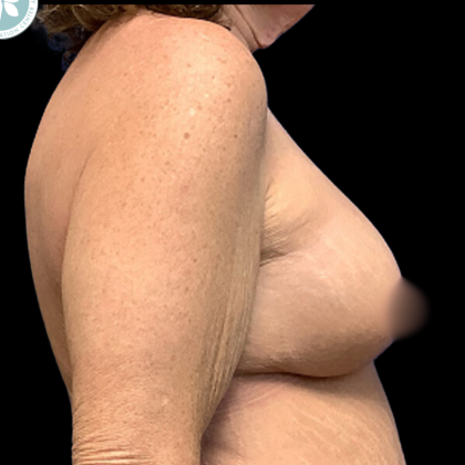 Breast Augmentation Before & After Patient #4952