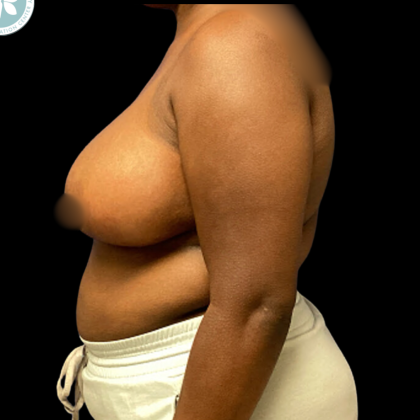 Breast Reduction Before & After Patient #4954