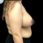 Breast Reduction Before & After Patient #4955