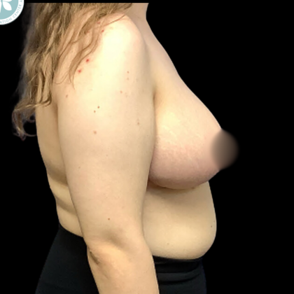Breast Reduction Before & After Patient #4955