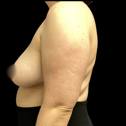 Breast Reduction Before & After Patient #4956