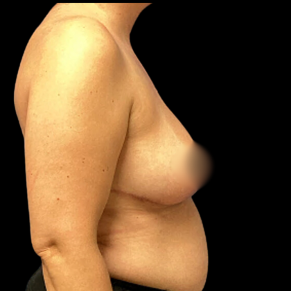 Breast Reduction Before & After Patient #4957