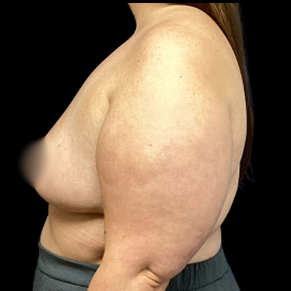 Breast Reduction Before & After Patient #4958