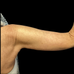 Arm Lift Before & After Patient #4891