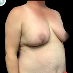 Breast Reduction Before & After Patient #4959