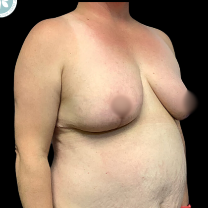 Breast Reduction Before & After Patient #4959