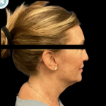 Facelift Before & After Patient #4960