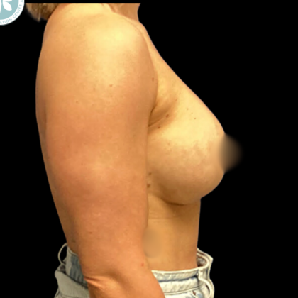 Implant Removal Before & After Patient #4961
