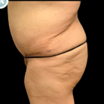 Liposuction Before & After Patient #4962