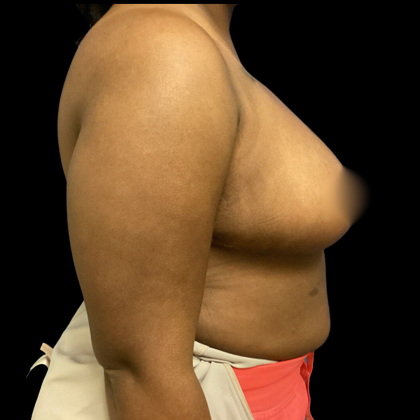 Breast Reduction Before & After Patient #4902